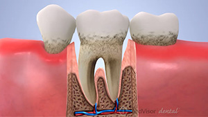 中等度歯周炎の画像